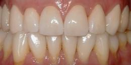 After: Porcelain Crowns (Caps)