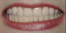 After: Dental Implants | Porcelain Crowns (Caps) 2