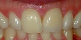 After: Dental Implants | Porcelain Crowns (Caps)