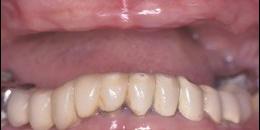 Before: Dental Implants | Porcelain Crowns (Caps) 2