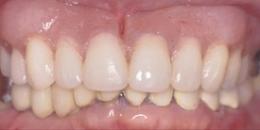 After: Dental Implants | Porcelain Crowns (Caps) 2