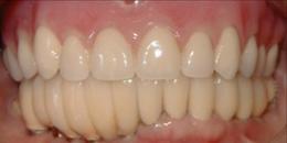 Before: Dental Implants | Porcelain Crowns (Caps) 2