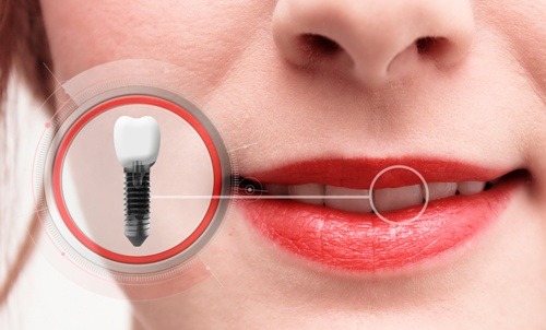 Mini Dental Implants Natick, MA