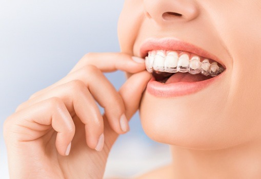 Invisalign invisible braces Natick, MA